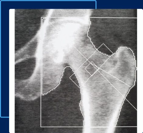A bone density scan of the hipbone.